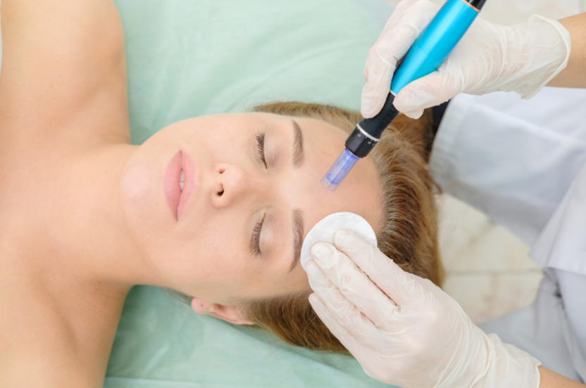 Microneedling Your Way to Radiant Skin