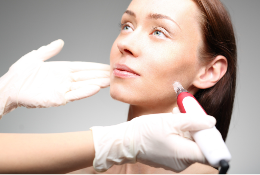 Microneedling Your Way to Radiant Skin